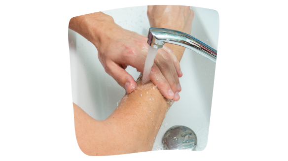 Persona che lava con cura una ferita sulla pelle con dermatite atopica. Persona che lava con cura una ferita sulla pelle con dermatite atopica.
